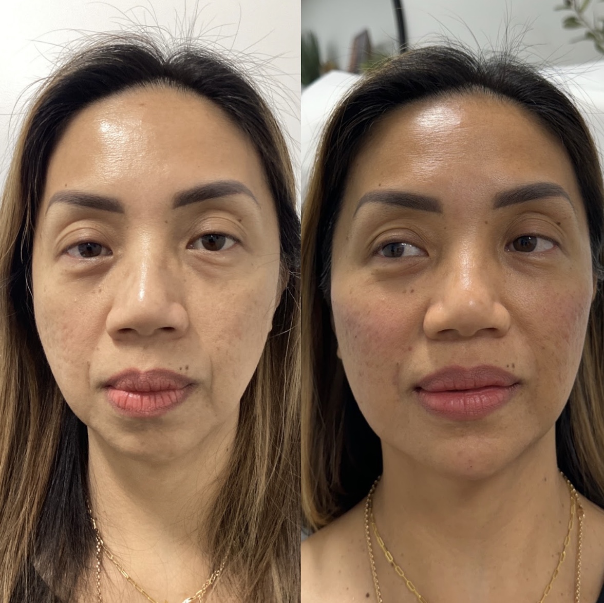 Before and after of a woman front facing option 3